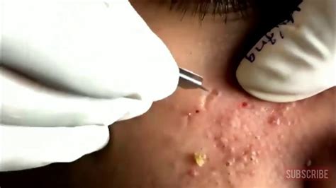 biggest popping pimples videos|extra large blackhead popping videos.